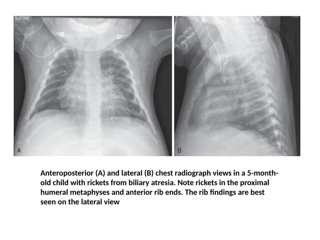 Rickets- radiology Dr jp,asst - slide 8 of 11