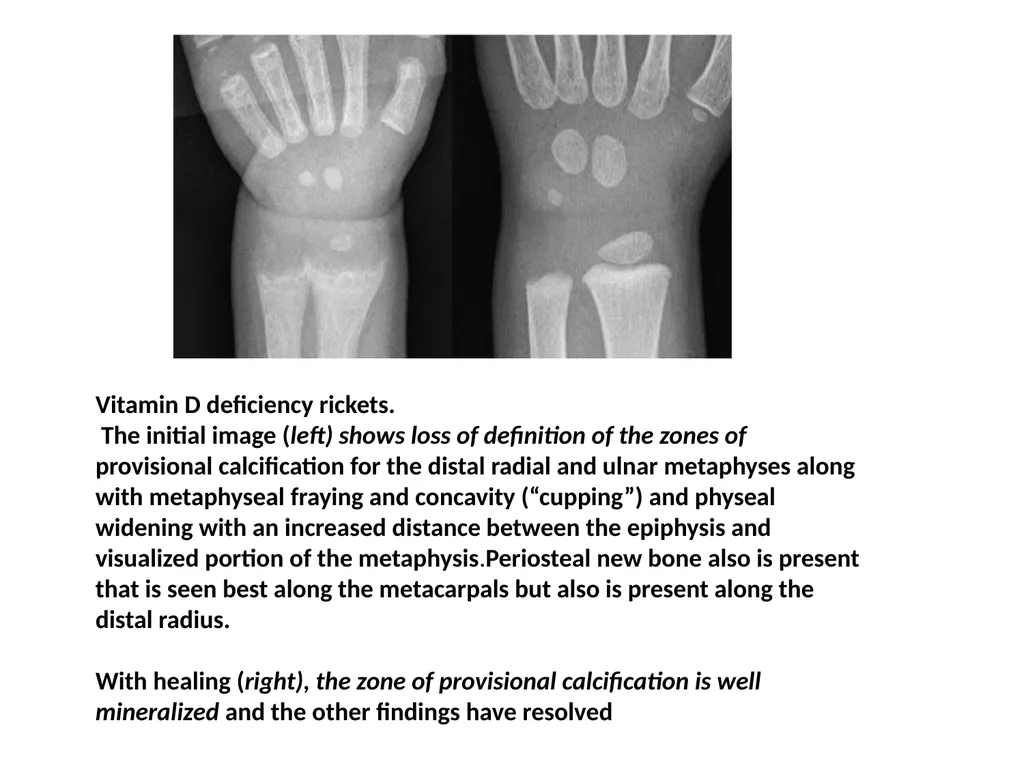 Rickets- radiology Dr jp,asst - slide 7 of 11