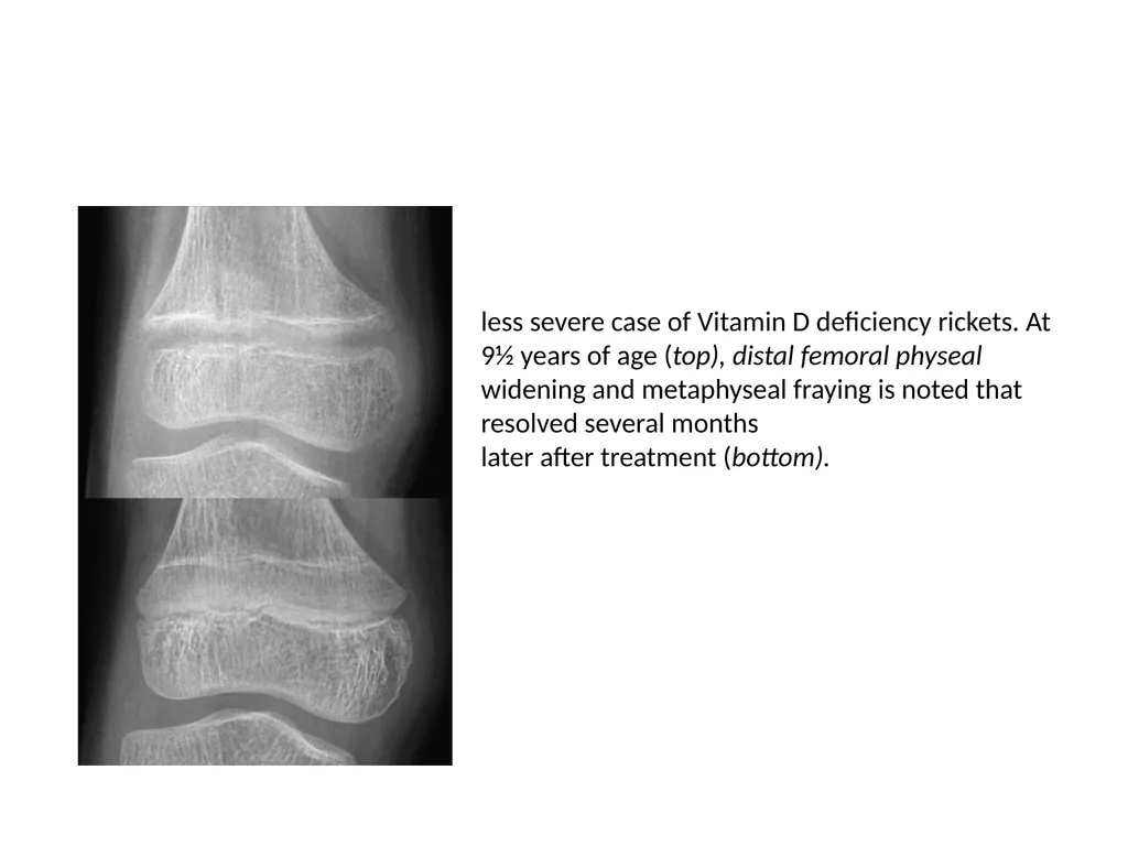 Rickets- radiology Dr jp,asst - slide 9 of 11