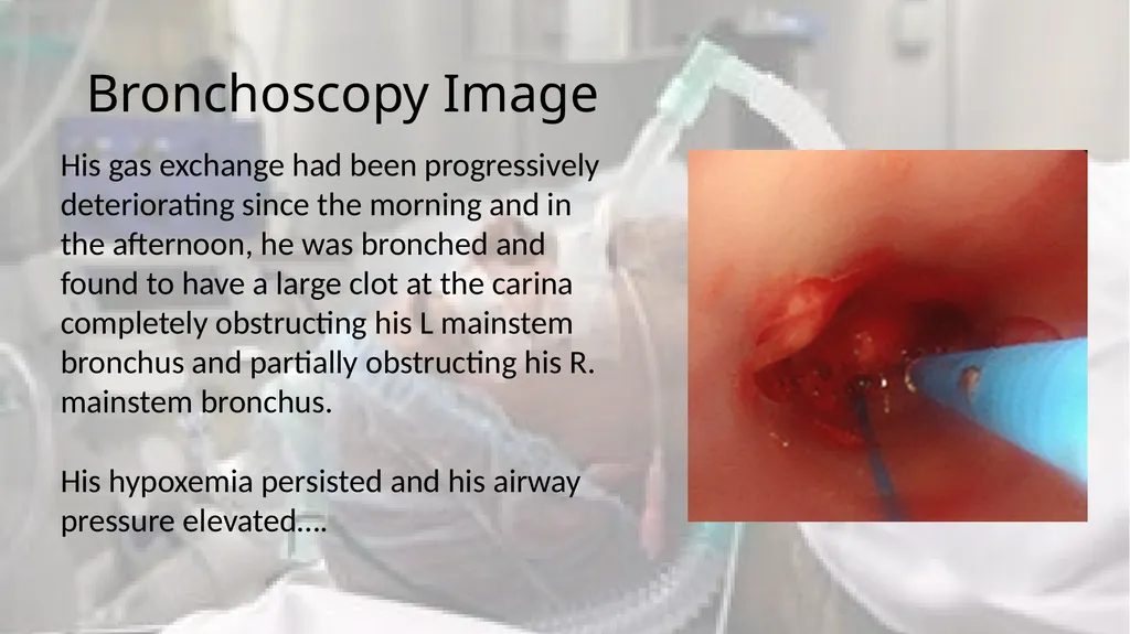 A Clot in the lung that will not come out - slide 5 of 13