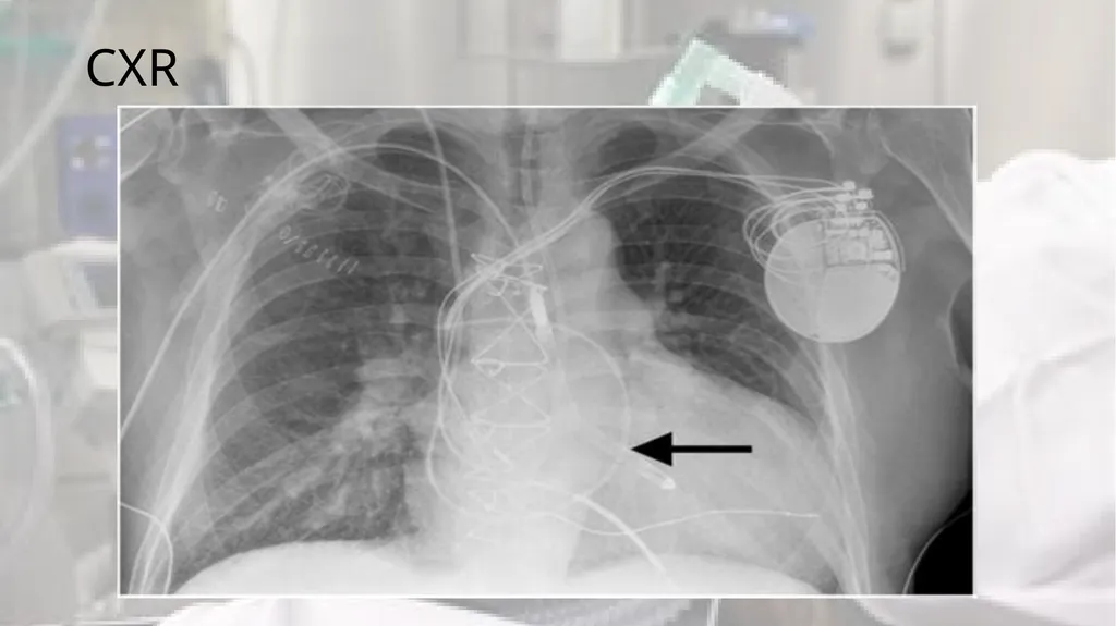 A Clot in the lung that will not come out - slide 3 of 13