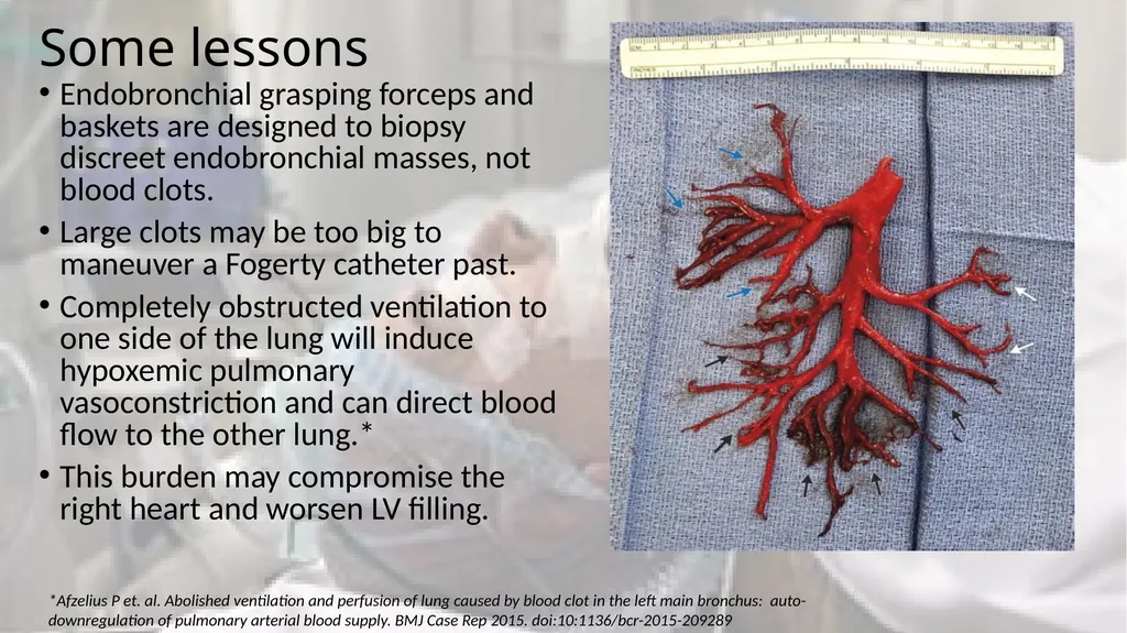 A Clot in the lung that will not come out - slide 13 of 13