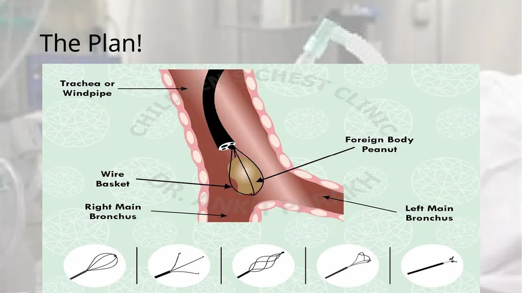 A Clot in the lung that will not come out - slide 10 of 13
