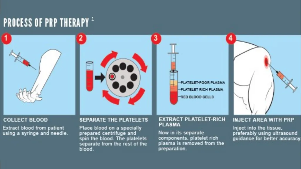 Physical Therapy Post-Platelet Rich Plasma - slide 3 of 15