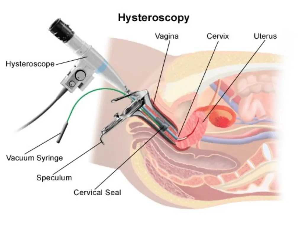 Gynecological endoscopy Laparoscopy and - slide 13 of 20