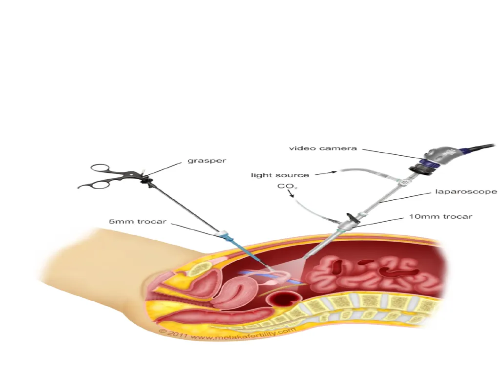 Gynecological endoscopy Laparoscopy and - slide 6 of 20