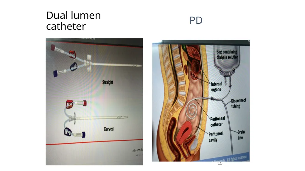 Transplantation surgery Dr. Ammar Fadil 1 History - slide 15 of 46