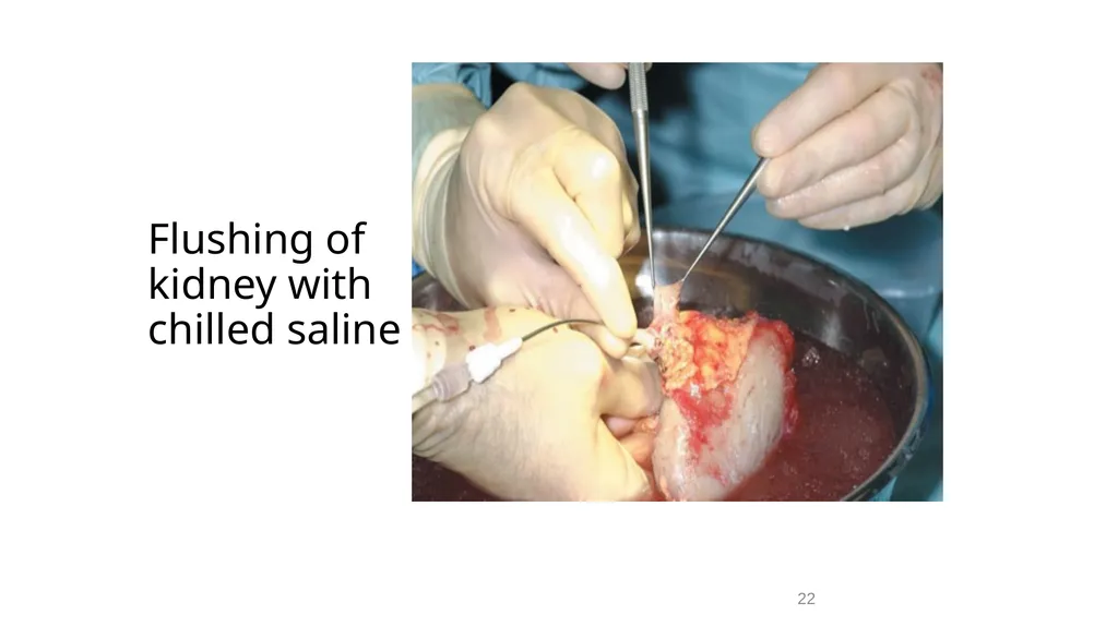 Transplantation surgery Dr. Ammar Fadil 1 History - slide 22 of 46