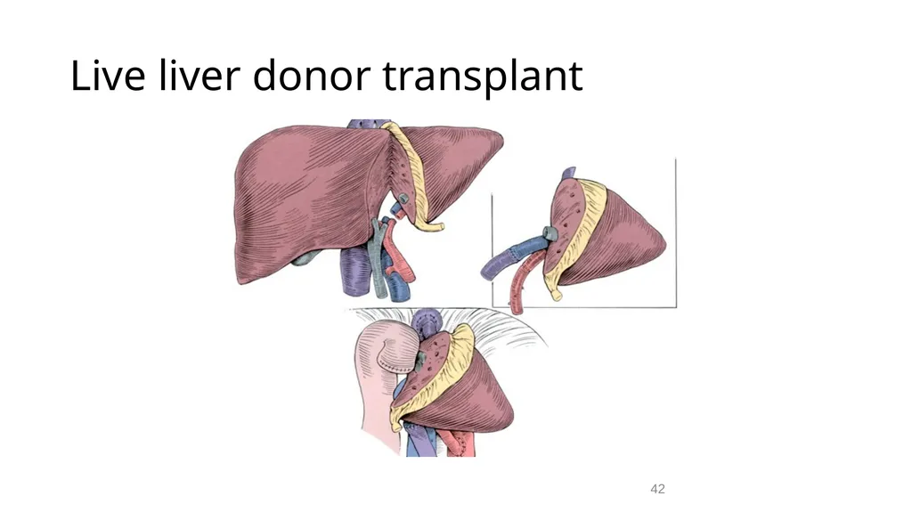 Transplantation surgery Dr. Ammar Fadil 1 History - slide 42 of 46