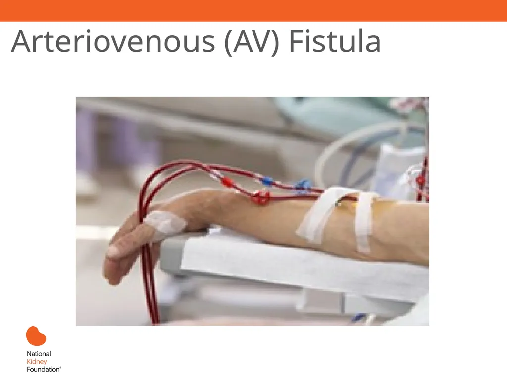 Renal Replacement Therapy: What the PCP Needs to - slide 24 of 64