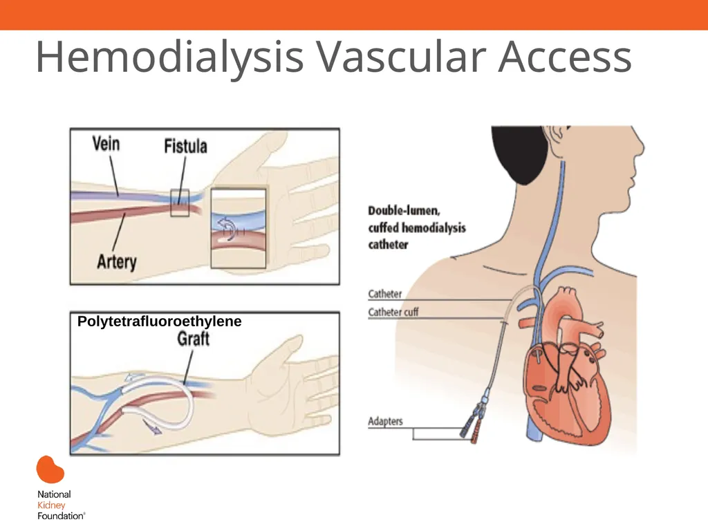 Renal Replacement Therapy: What the PCP Needs to - slide 23 of 64