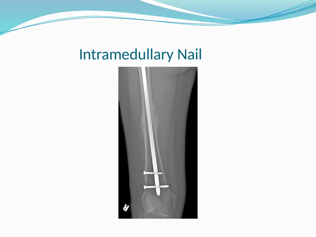 Physical Therapy After Upper Leg Injuries Mgr. - slide 28 of 60