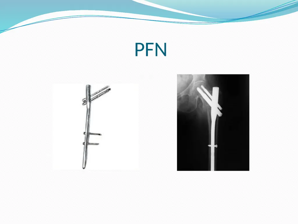 Physical Therapy After Upper Leg Injuries Mgr. - slide 12 of 60