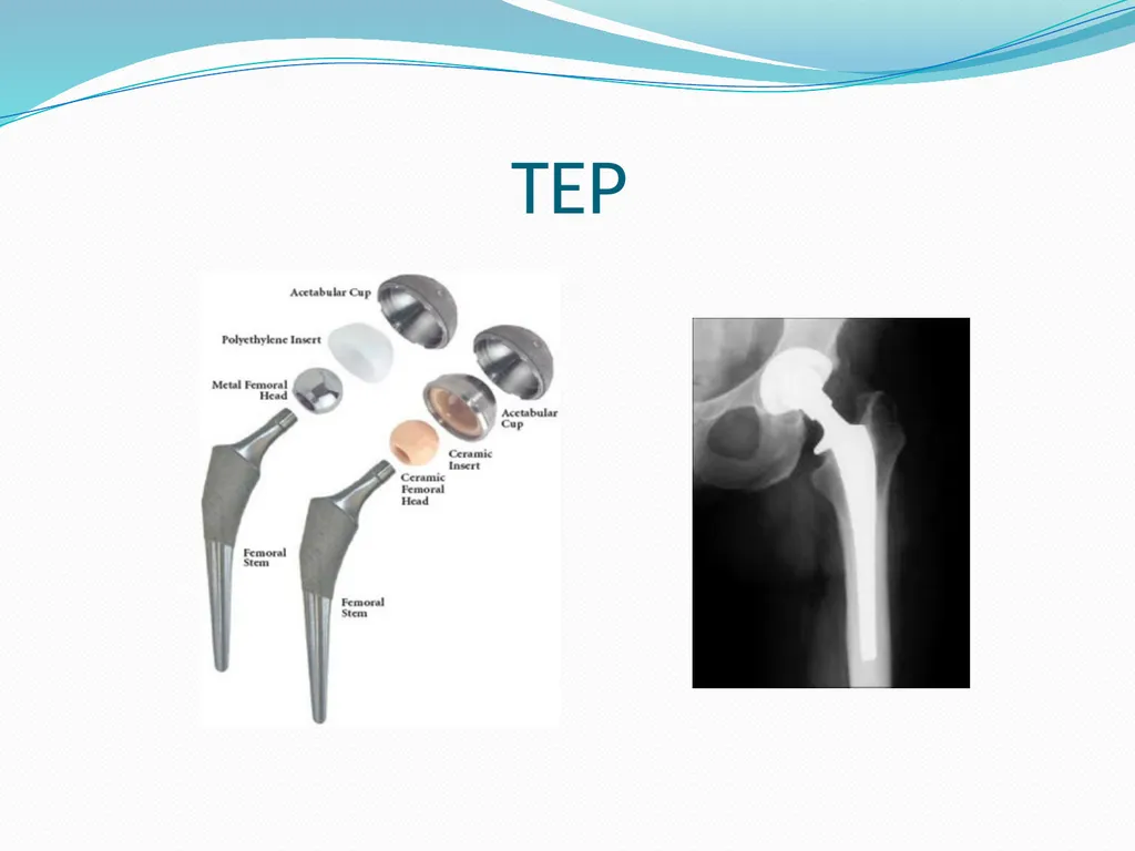 Physical Therapy After Upper Leg Injuries Mgr. - slide 10 of 60