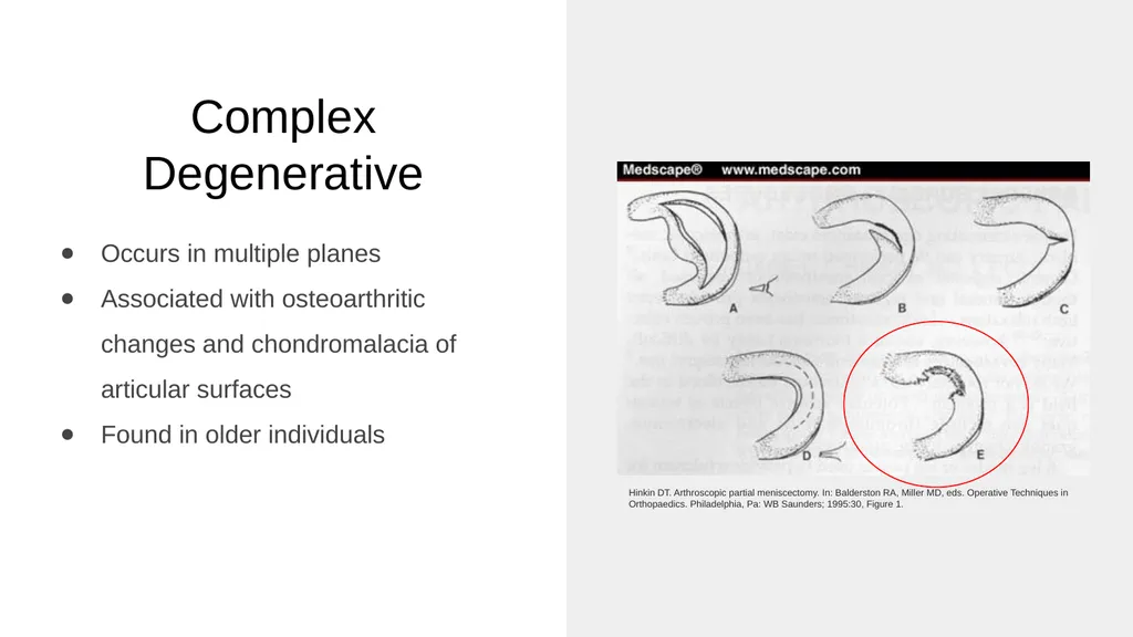 The Meniscus: Injuries, Management and - slide 25 of 74