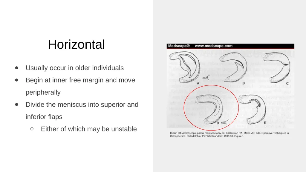 The Meniscus: Injuries, Management and - slide 23 of 74