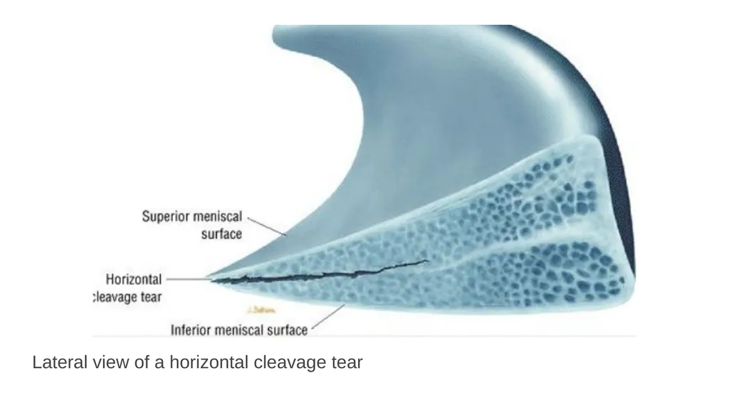 The Meniscus: Injuries, Management and - slide 24 of 74