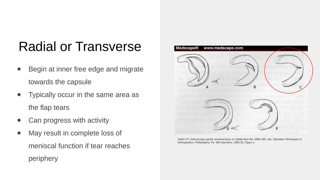 The Meniscus: Injuries, Management and - slide 22 of 74