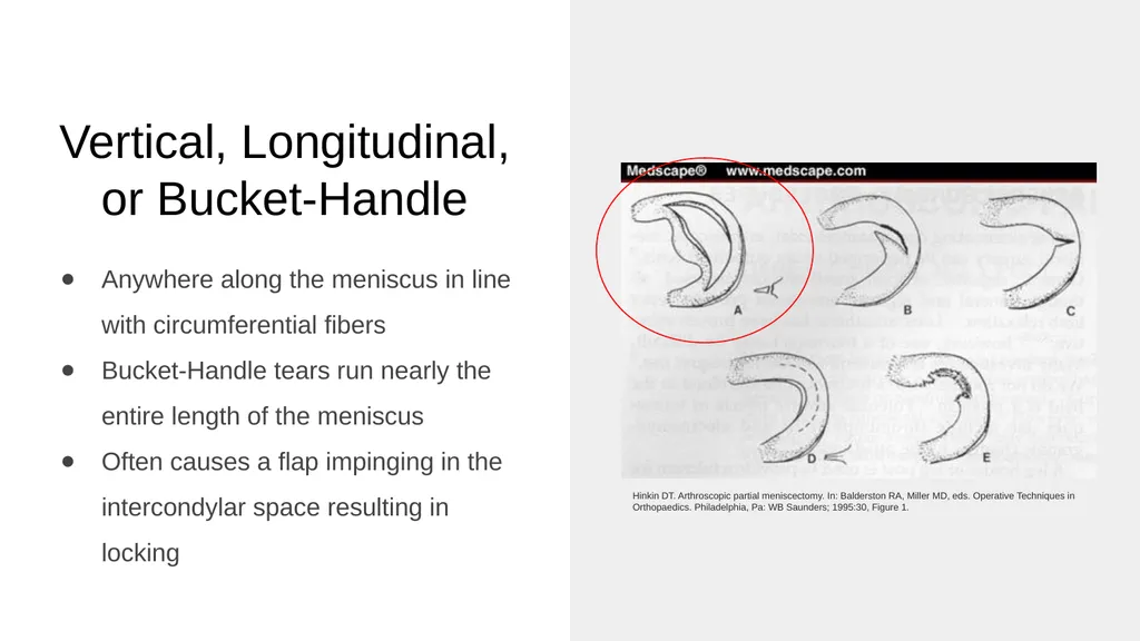 The Meniscus: Injuries, Management and - slide 20 of 74