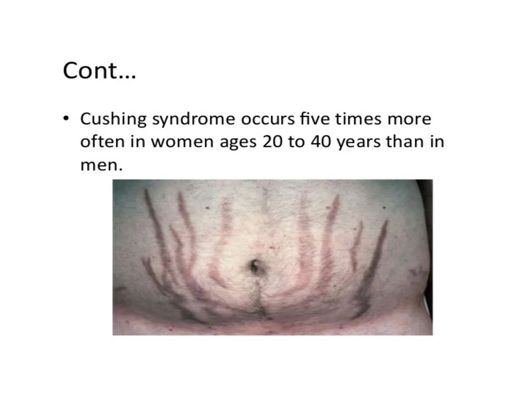 Addison's disease - slide 15 of 33