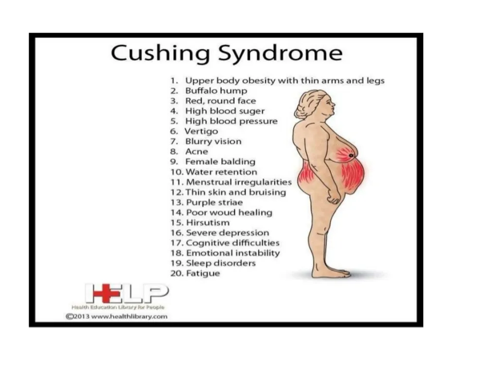 Addison's disease - slide 21 of 33