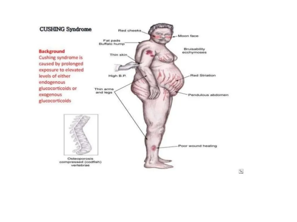 Addison's disease - slide 22 of 33