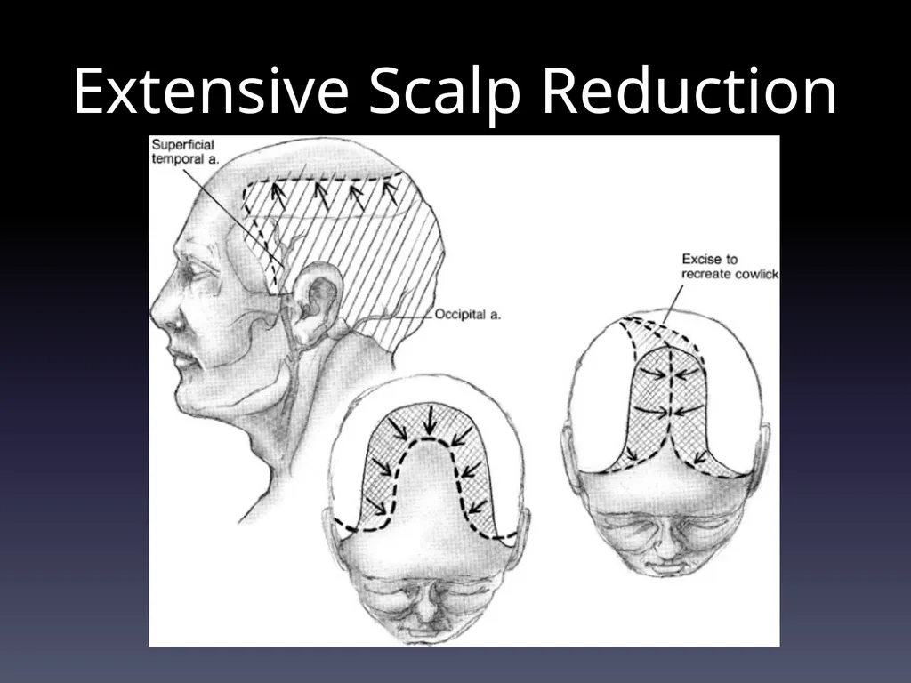 Management of Alopecia Ashley Balaker, MD March - slide 25 of 29