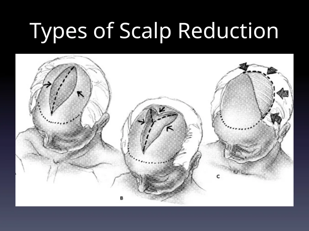 Management of Alopecia Ashley Balaker, MD March - slide 20 of 29