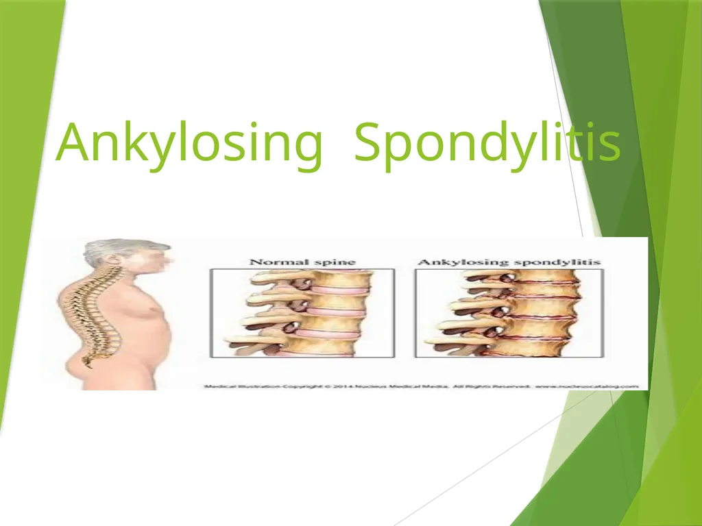 Ankylosing Spondylitis Pathology Ankylosing - slide 1 of 25