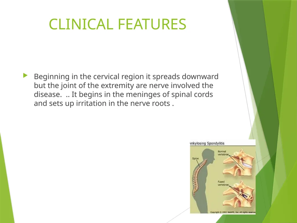 Ankylosing Spondylitis Pathology Ankylosing - slide 7 of 25