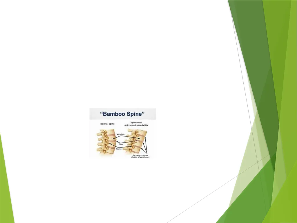 Ankylosing Spondylitis Pathology Ankylosing - slide 13 of 25