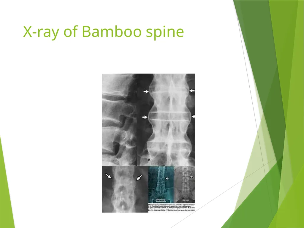Ankylosing Spondylitis Pathology Ankylosing - slide 16 of 25