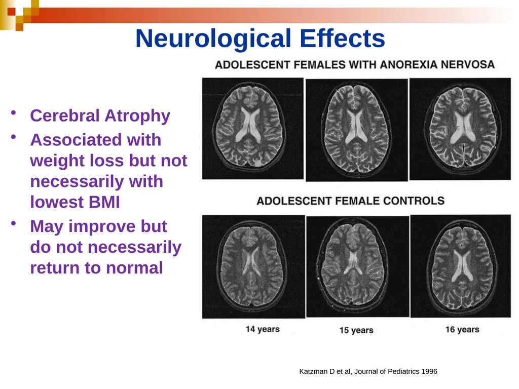 Eating Disorders 21 November 2013 Krissy Schwerin, - slide 10 of 46