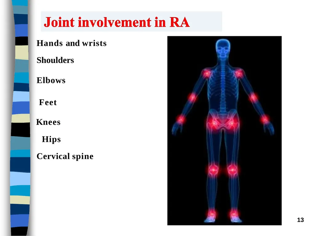 RHEUMATOID ARTHRITIS Doç.Dr.Demet Tekdöş - slide 13 of 31