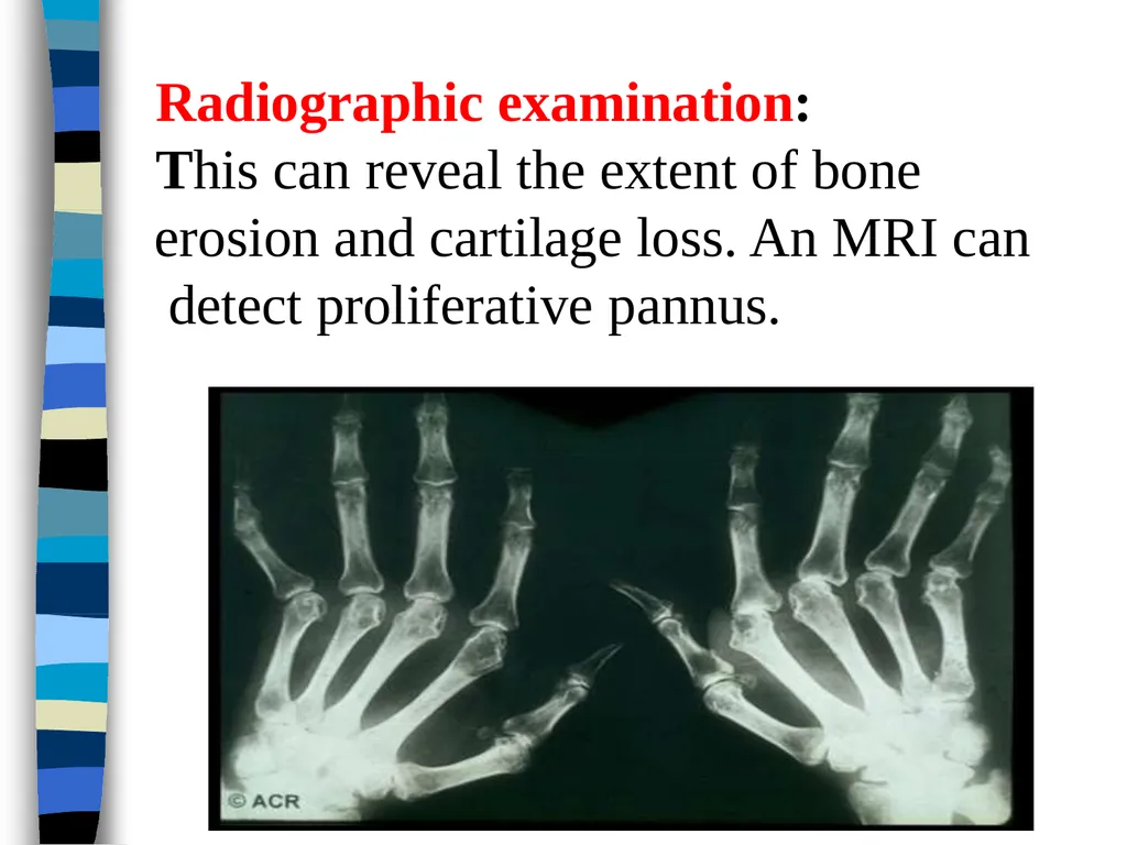 RHEUMATOID ARTHRITIS Doç.Dr.Demet Tekdöş - slide 24 of 31