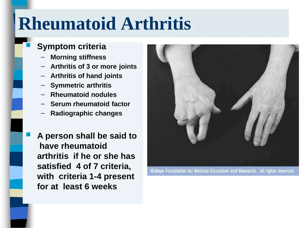 RHEUMATOID ARTHRITIS Doç.Dr.Demet Tekdöş - slide 25 of 31
