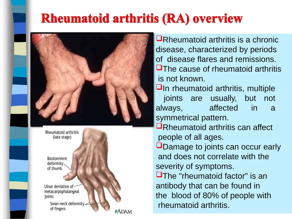 RHEUMATOID ARTHRITIS Doç.Dr.Demet Tekdöş - slide 5 of 31
