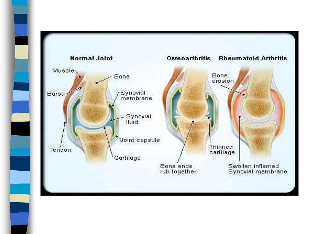 RHEUMATOID ARTHRITIS Doç.Dr.Demet Tekdöş - slide 6 of 31