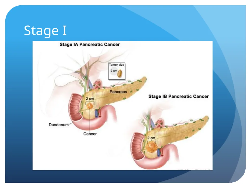 Pancreatic cancer By Linda Sircy Where is the - slide 13 of 19