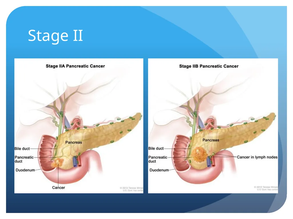 Pancreatic cancer By Linda Sircy Where is the - slide 14 of 19