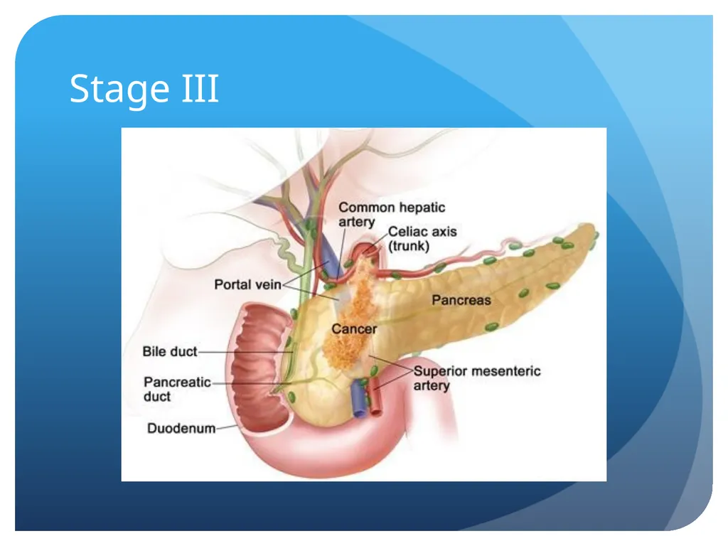 Pancreatic cancer By Linda Sircy Where is the - slide 15 of 19