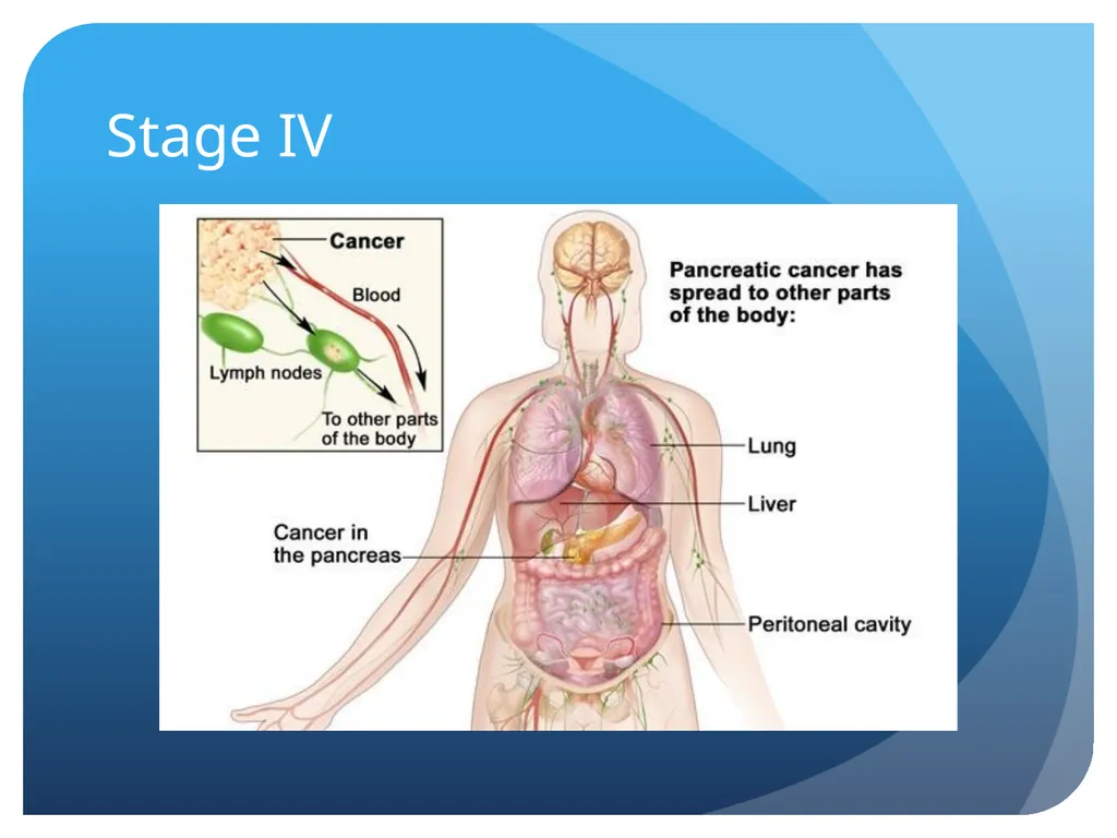 Pancreatic cancer By Linda Sircy Where is the - slide 16 of 19