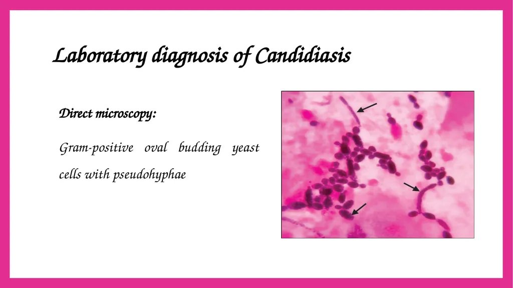 SYSTEMIC CANDIDIASIS Dr. Priyanka Chaturvedi - slide 13 of 28