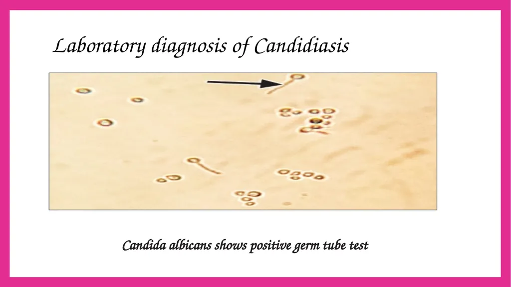 SYSTEMIC CANDIDIASIS Dr. Priyanka Chaturvedi - slide 16 of 28