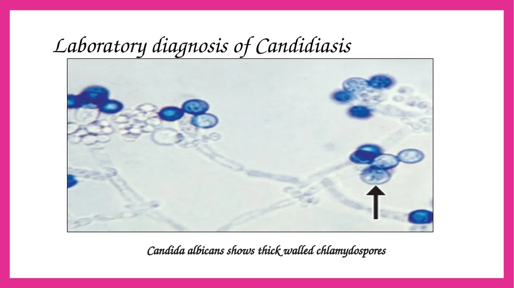 SYSTEMIC CANDIDIASIS Dr. Priyanka Chaturvedi - slide 17 of 28