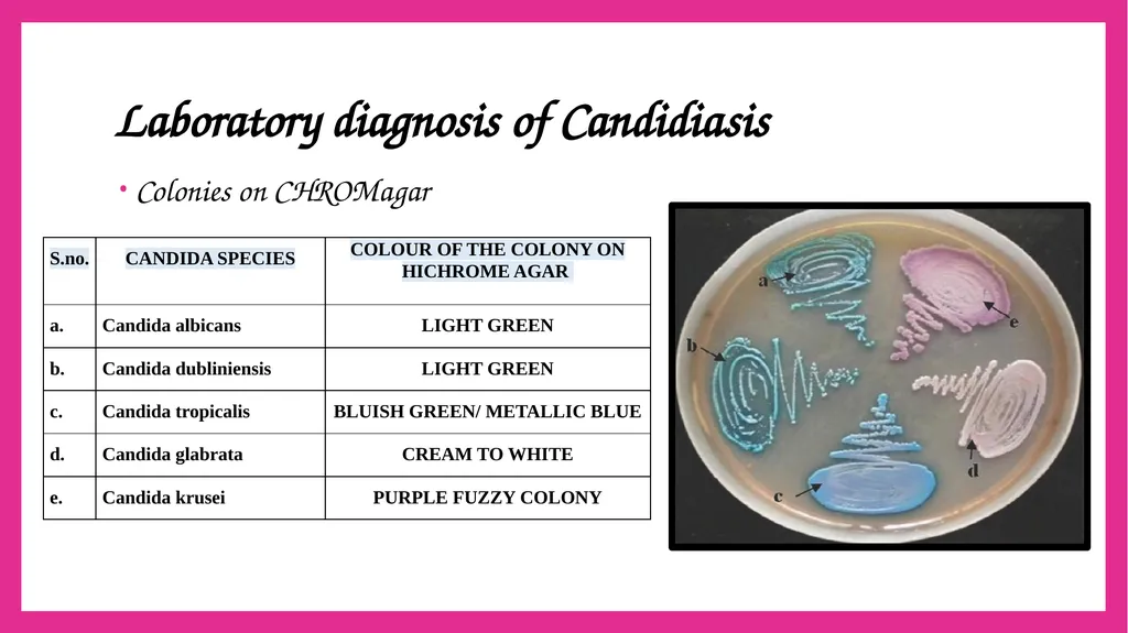 SYSTEMIC CANDIDIASIS Dr. Priyanka Chaturvedi - slide 18 of 28