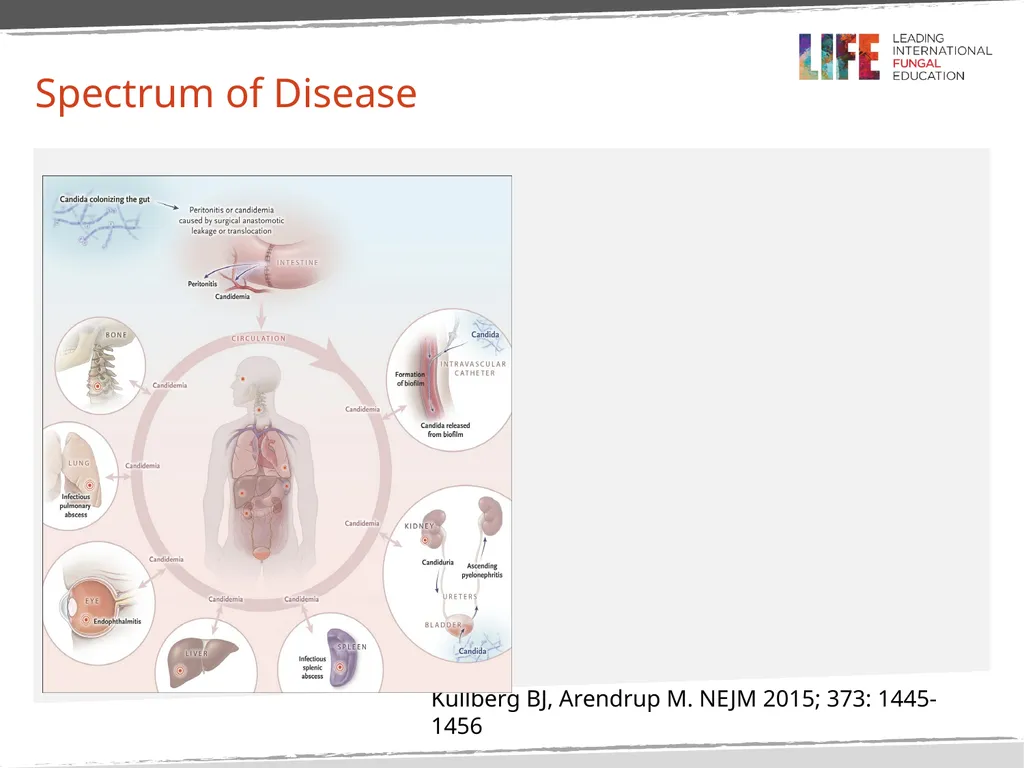 Intra-Abdominal Candidiasis, Candida peritonitis - slide 3 of 15
