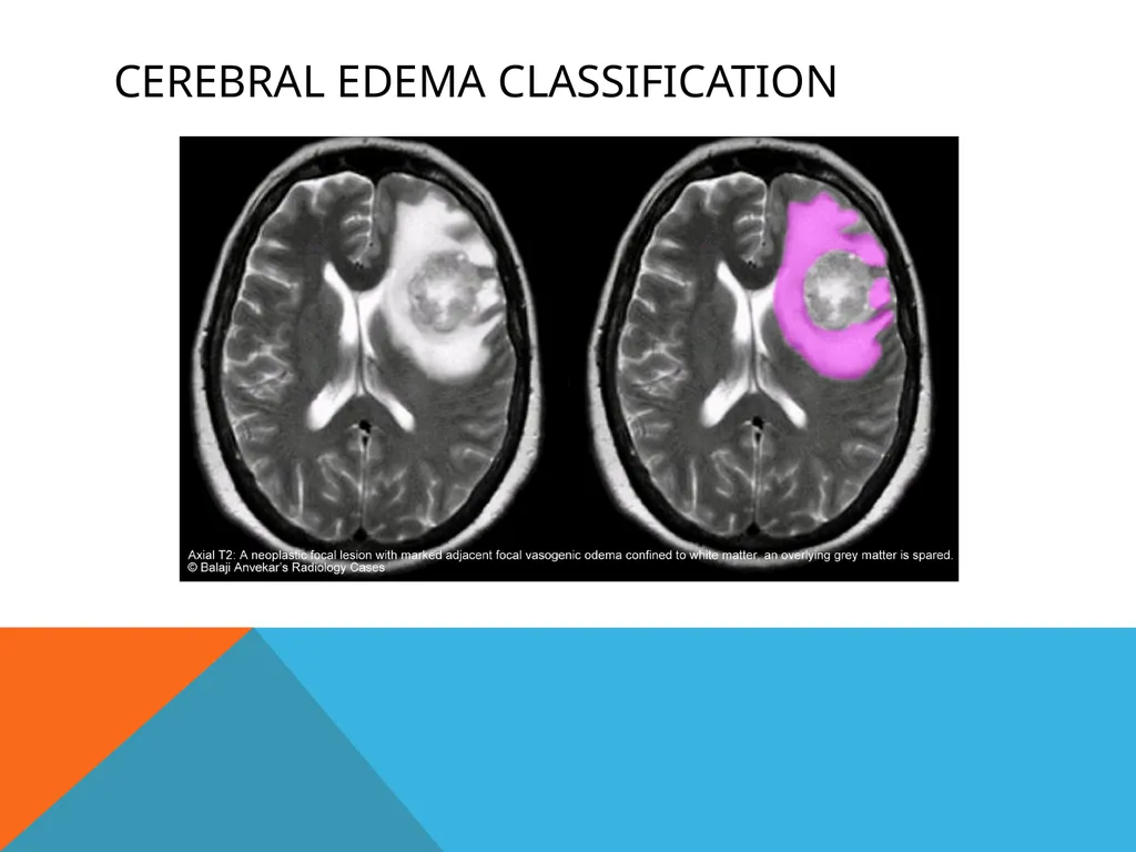 Cerebral Edema Yikes! Jameson E. Crumb, PA-C What - slide 12 of 28