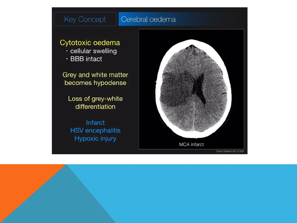 Cerebral Edema Yikes! Jameson E. Crumb, PA-C What - slide 9 of 28