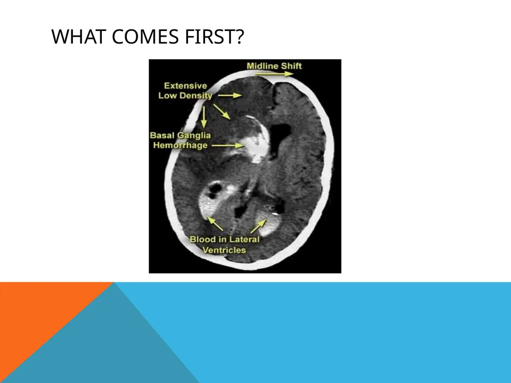 Cerebral Edema Yikes! Jameson E. Crumb, PA-C What - slide 14 of 28